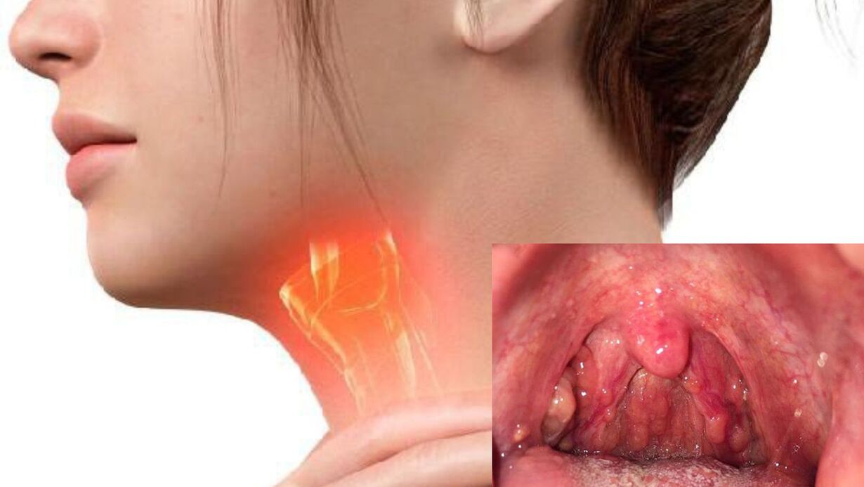 Hình ảnh amidan bị sưng viêm gây ra triệu chứng vướng cổ họng 