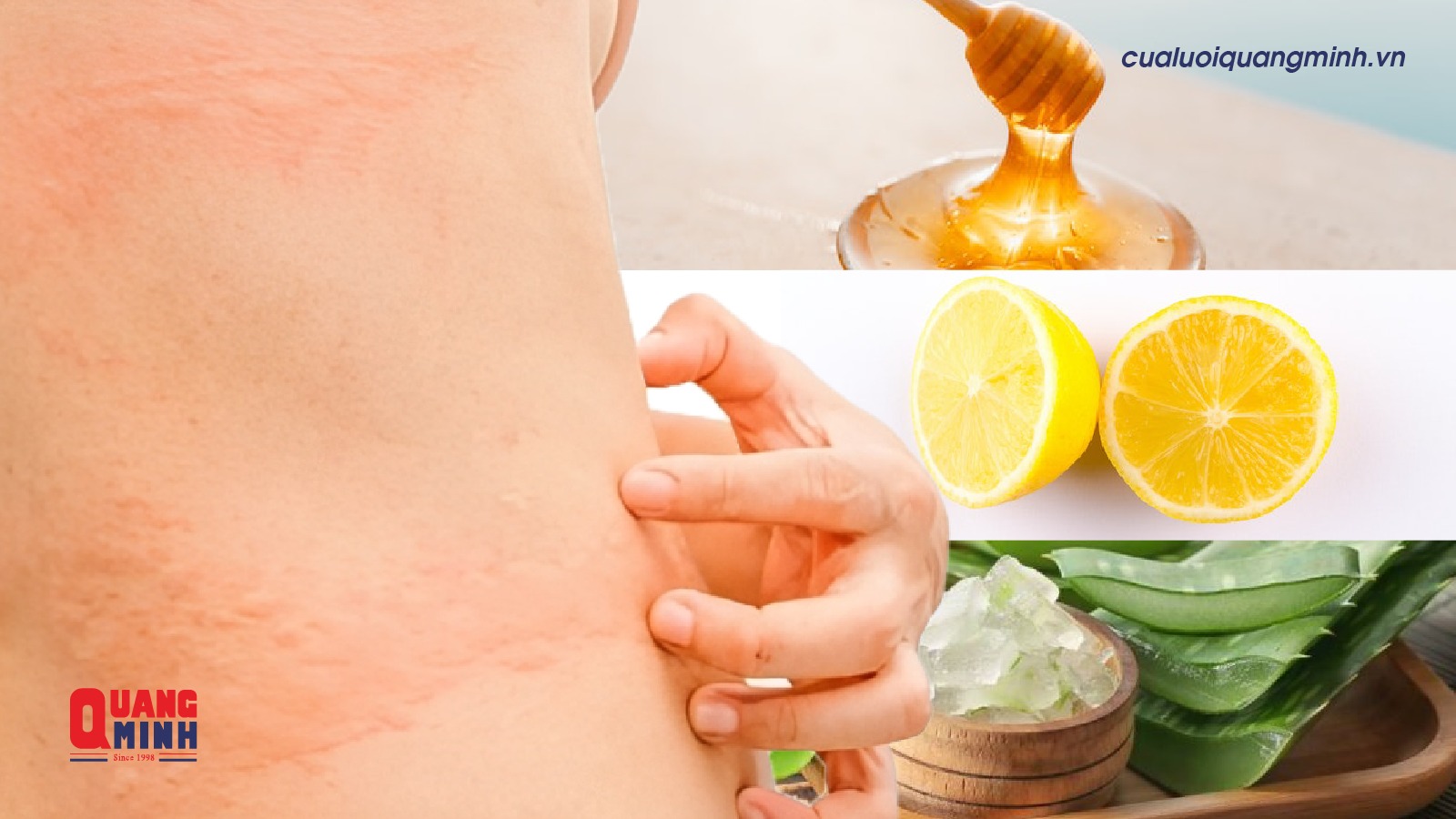 ảnh bìa của mẹo trị dị ứng thức ăn