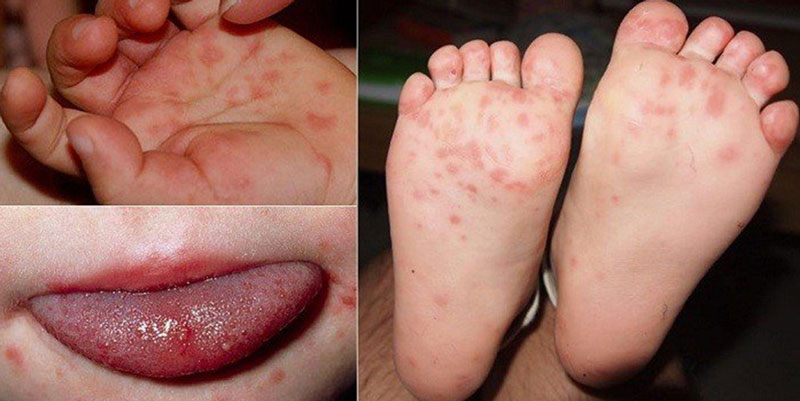 Dấu hiệu trẻ bị tay chân miệng: nổi mẩn đỏ ở lưỡi, lòng bàn tay, bàn chân