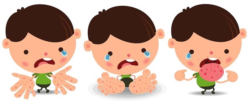 Hình ảnh ba em bé khóc do bị nổi mẩn ở vùng tay, chân, miệng
