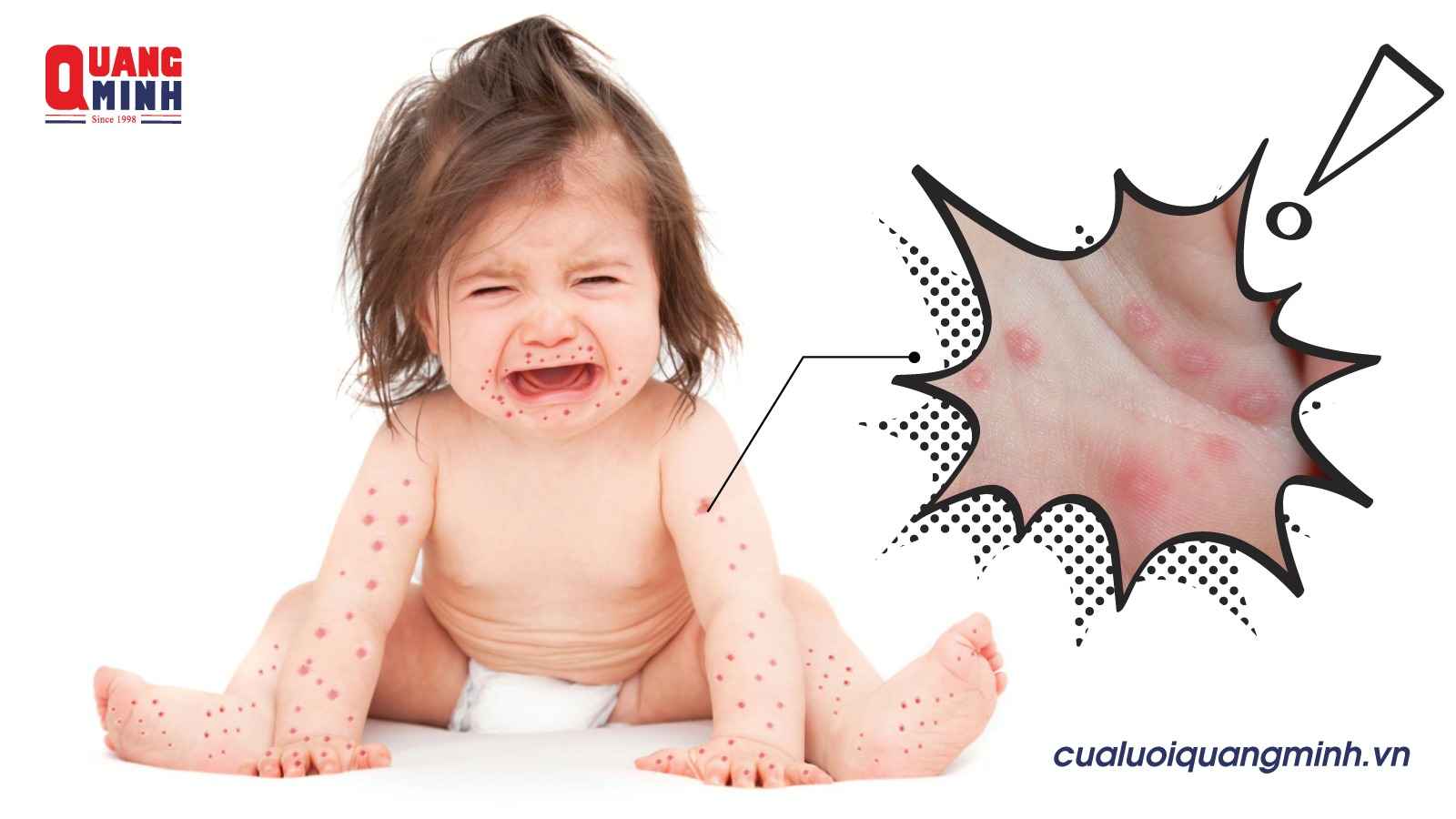 một bé gái đang ngồi khóc do tay, chân và miệng nổi nhiều vết đỏ
