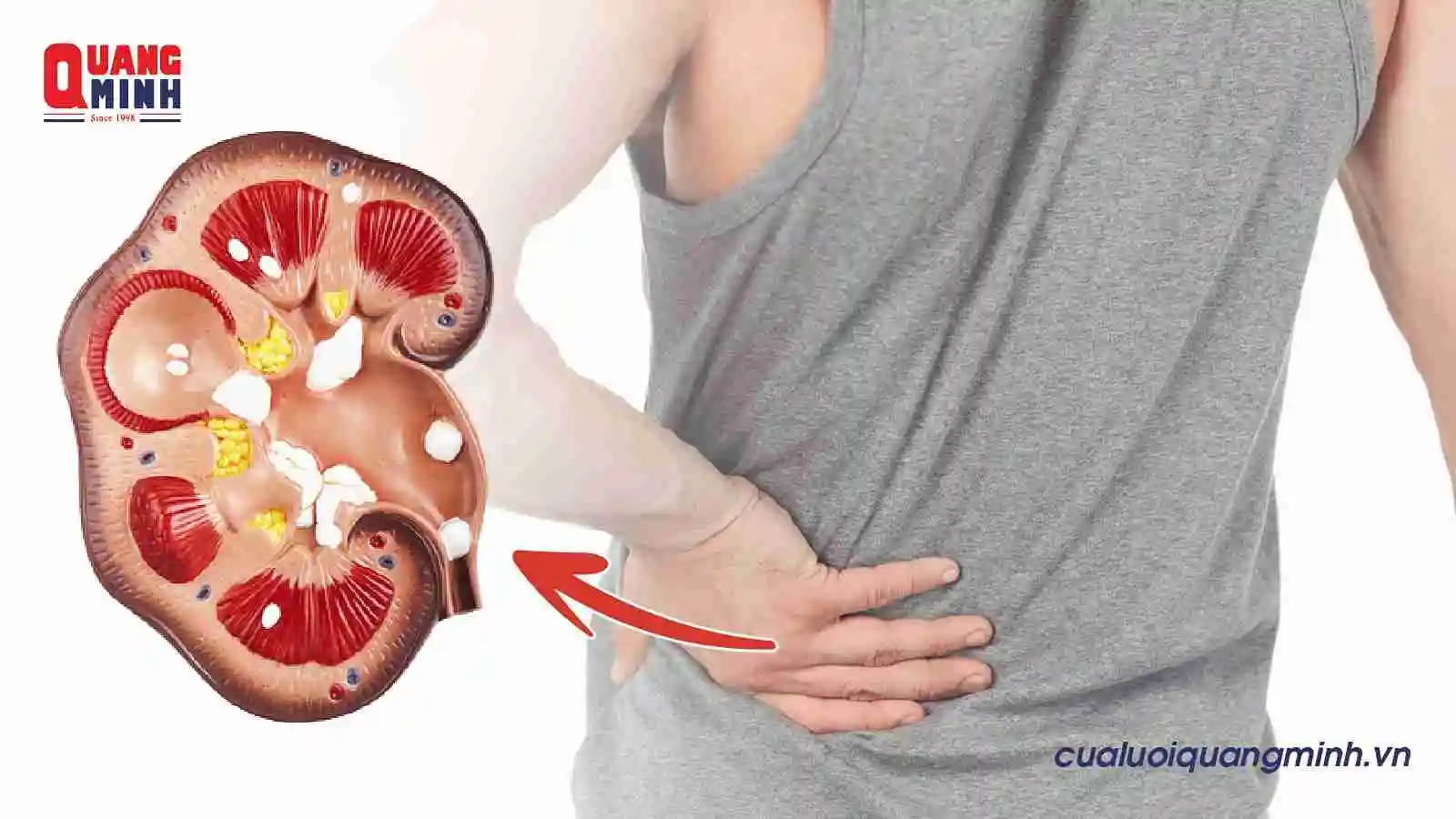 Sỏi thận của 1 người được mô tả chi tiết cụ thể