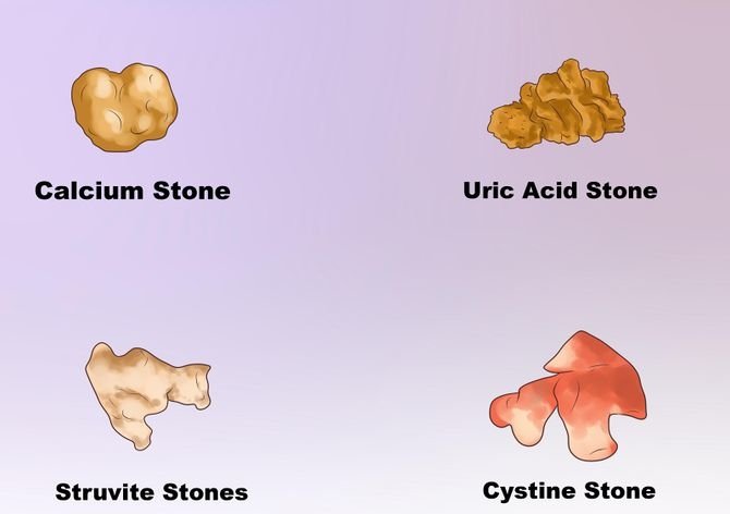 4 loại sỏi thận: Sỏi calci, Sỏi urat, Sỏi Struvite, Cystine 